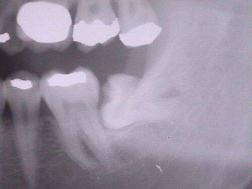 Denti del giudizio, non sempre è necessario rimuoverli. Ecco quando è necessario