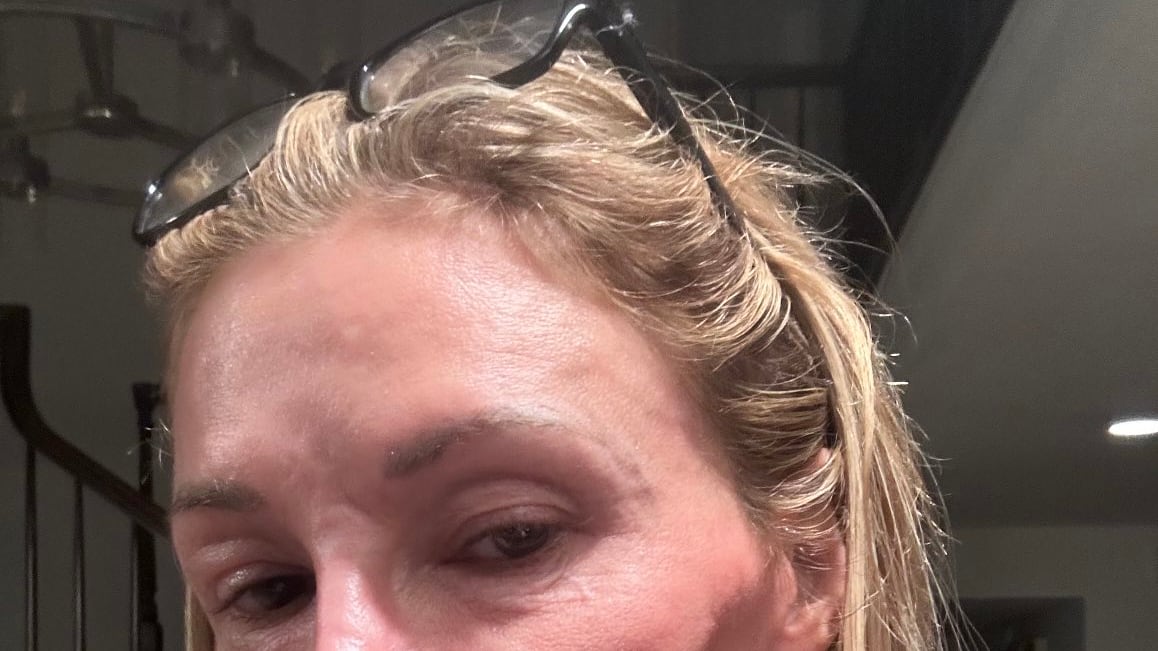 "Ho un parassita nel mio viso", l'agghiacciante storia dell'attrice Brandi Glanville