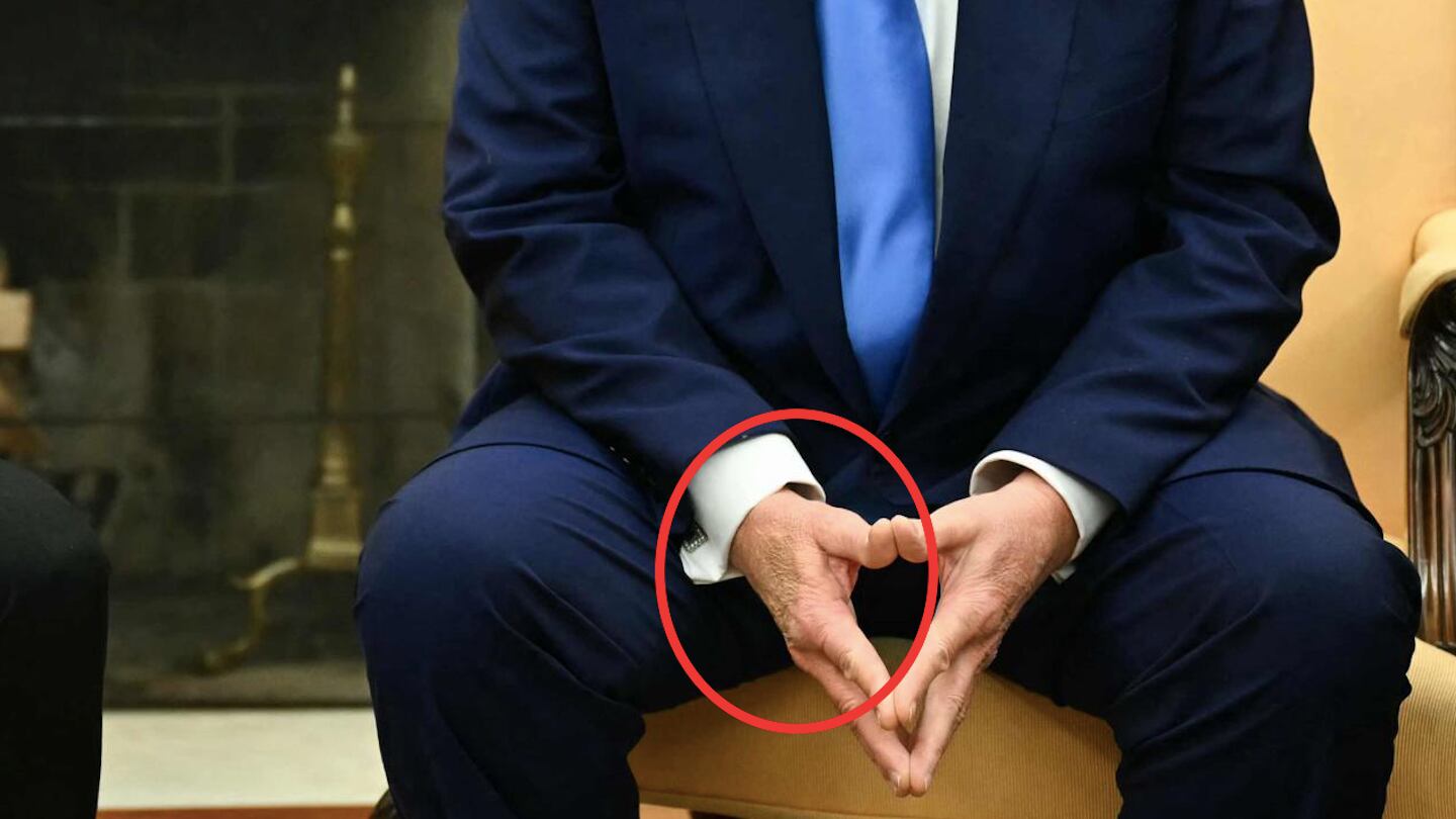 Cosa ha fatto Trump alla mano? Mistero sui social, ma spunta la verità sul livido