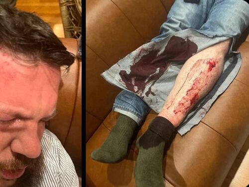 Il raid e le 15 martellate, Volokv pestato a sangue: "Volevano fare di me una cotoletta"