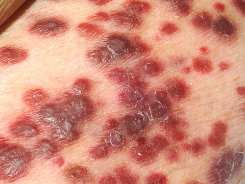 Sarcoma, di cosa si tratta e come si manifesta