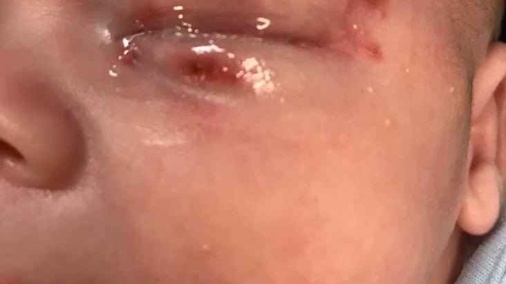 Baciato da un parente con l'Herpes: neonato rischia di morire