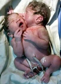 India, i gemelli con un corpo solo 4