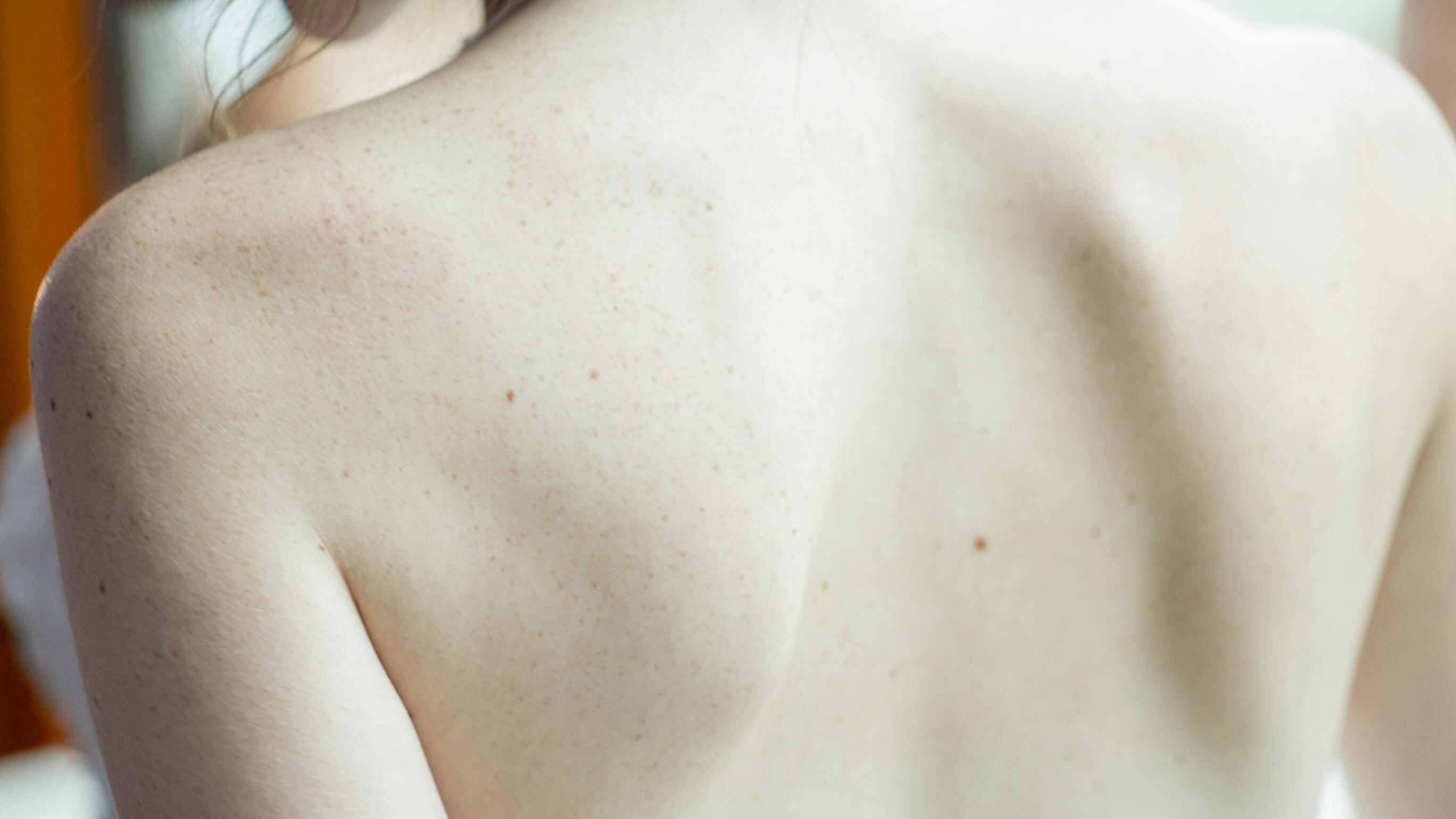 Melanoma: 10 consigli del dermatologo per prevenirlo