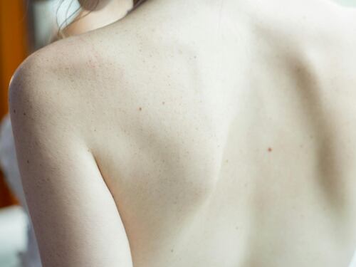 Melanoma: 10 consigli del dermatologo per prevenirlo