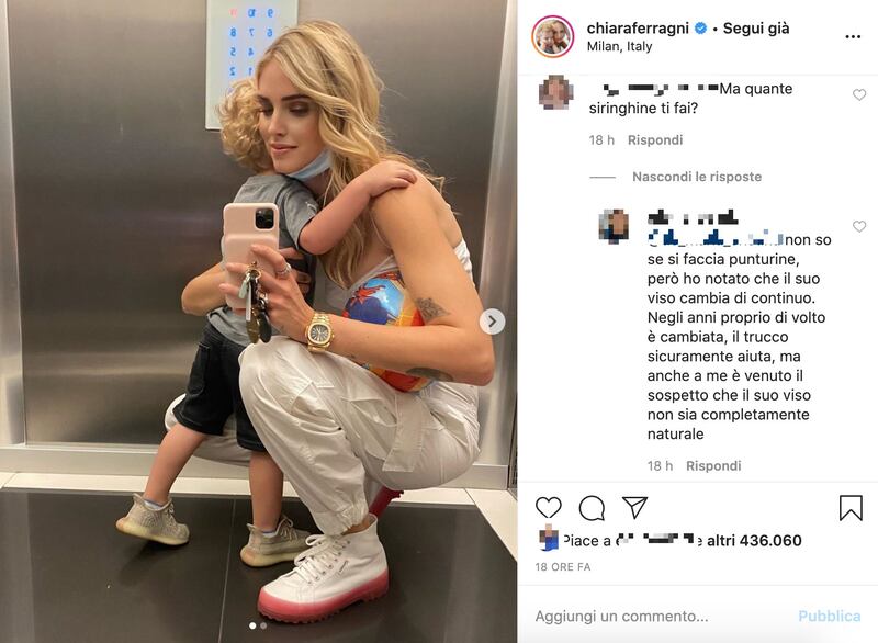 Chiara Ferragni, il sospetto del botox