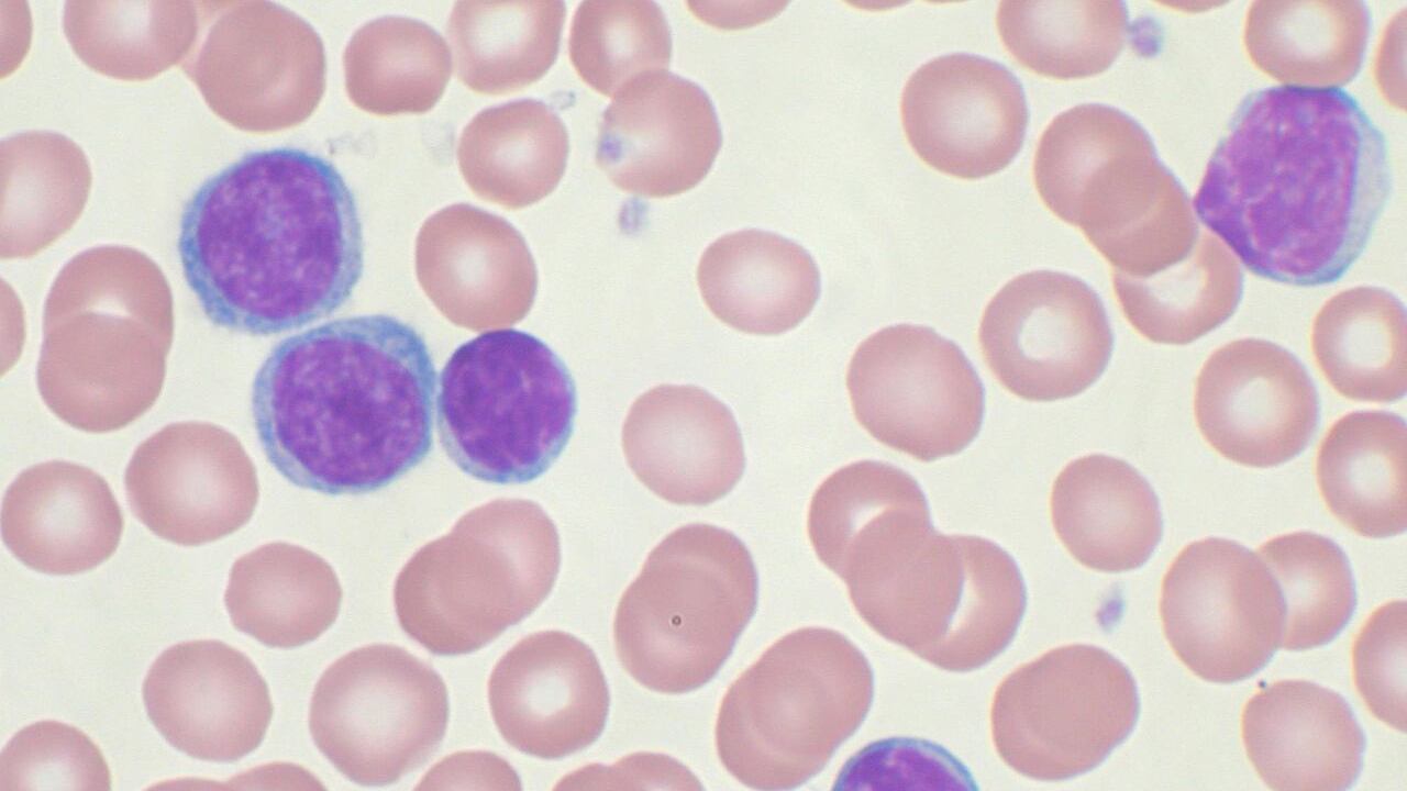 Leucemia linfatica cronica, nuove speranze dalla ricerca: le terapie per contrastare la patologia
