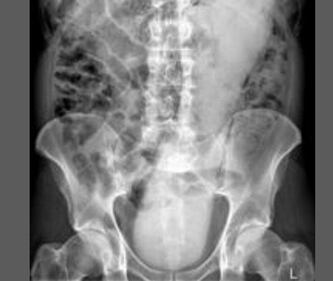 Pazze radiografie: gli oggetti che possono finire nel corpo umano 2