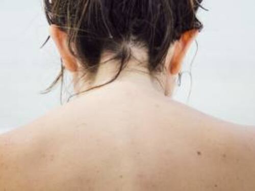 Allergia al sole, quali sono i sintomi e come si cura