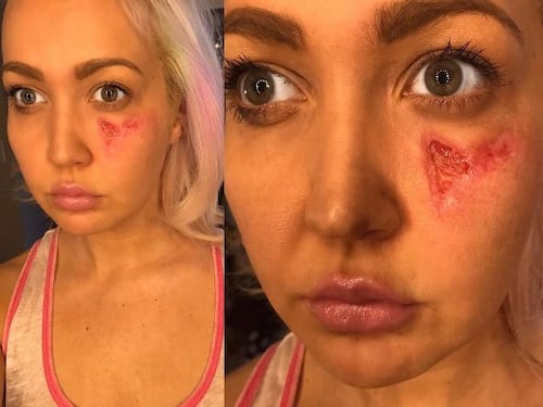 Meghan Linsey morsa da un ragno violino: "Sono contenta di essere viva"