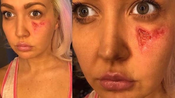 Meghan Linsey morsa da un ragno violino: "Sono contenta di essere viva"