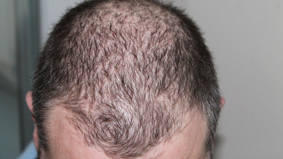 Cura della calvizie: nell’80% dei pazienti i capelli ricrescono