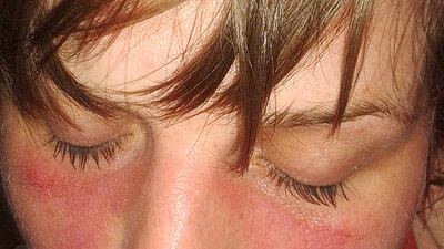 Lupus eritematoso sistemico, quali sono i sintomi?