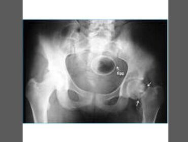 Pazze radiografie: gli oggetti che possono finire nel corpo umano 4