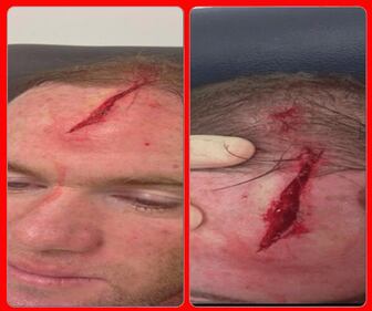Rooney pubblica le foto del suo infortunio e sul web scatta la satira 7