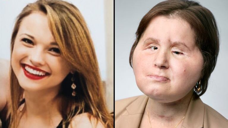 Il nuovo volto di Katie dopo il tentato suicidio: "La vita? È preziosa"