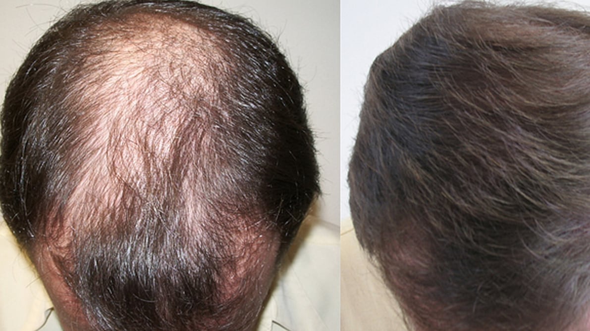 Alopecia, ecco il farmaco che fa recuperare tutti i capelli