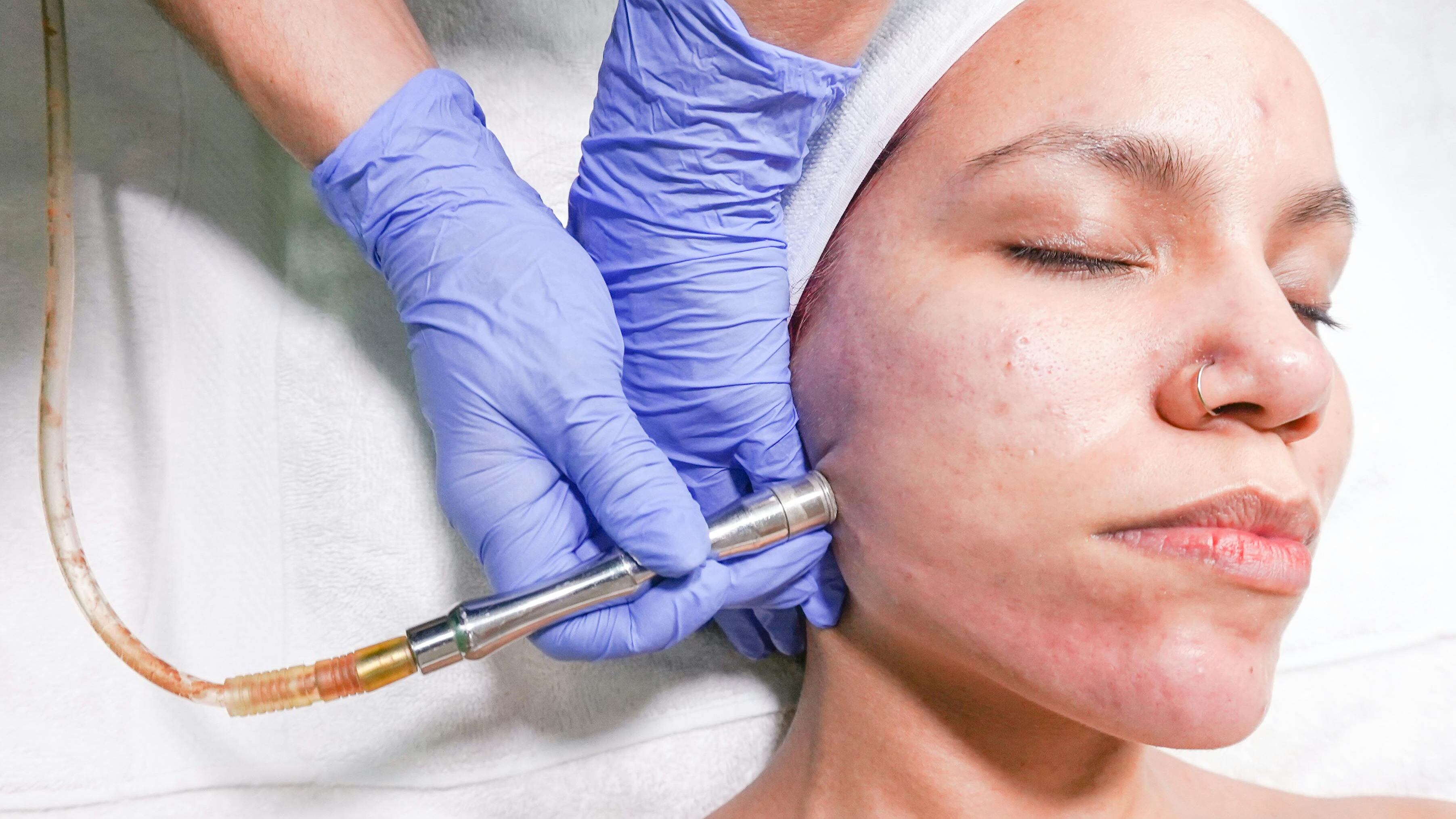 Acne, diagnosi in aumento soprattutto sulle donne: nuove cure e 10 errori da evitare secondo la dermatologa