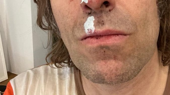Liam Gallagher e il volto tumefatto: cos'è successo