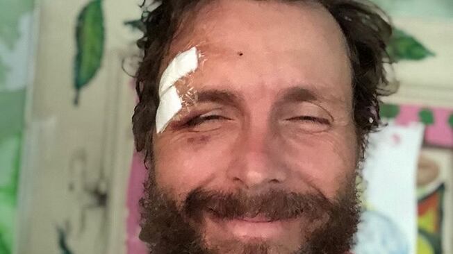 Incidente per Jovanotti che mostra i punti sul sopracciglio: "Non è niente”