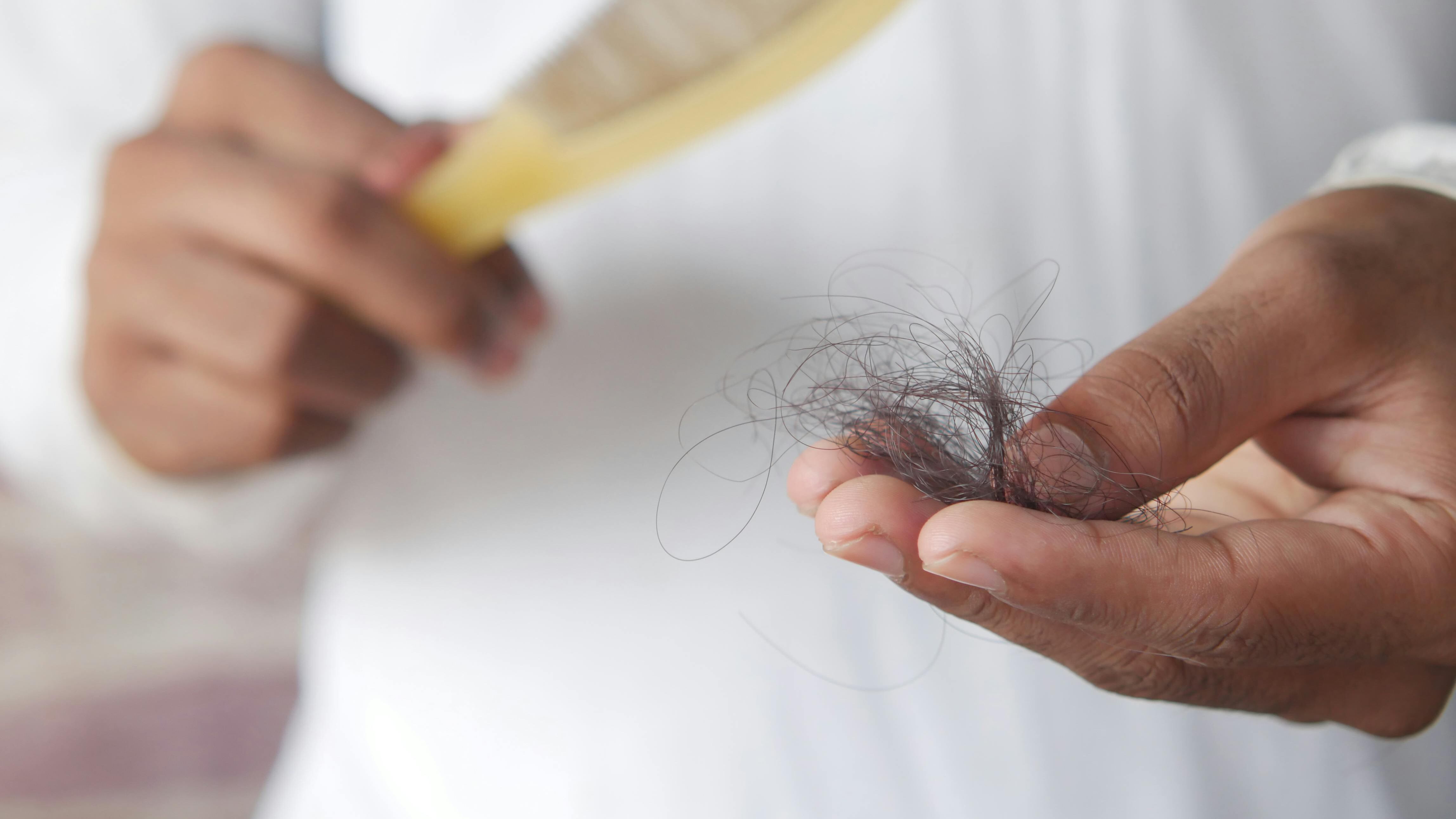 Alopecia da stress: ecco come riconoscerla