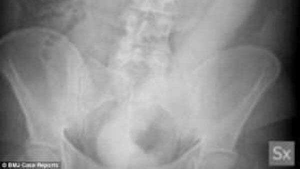 "Aiuto, ho male alla pancia": ma nel retto ha dildo di 60cm. I medici del Niguarda lo salvano