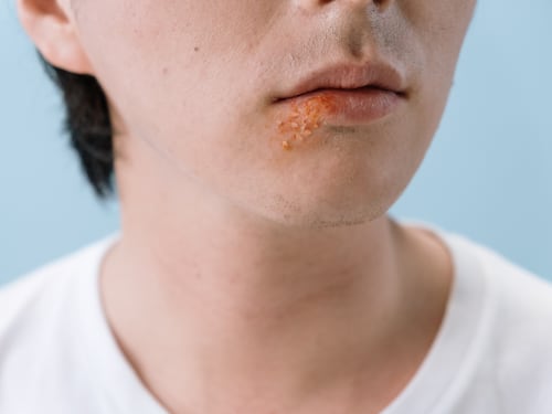 Ecco come l'herpes può distruggere le cellule tumorali