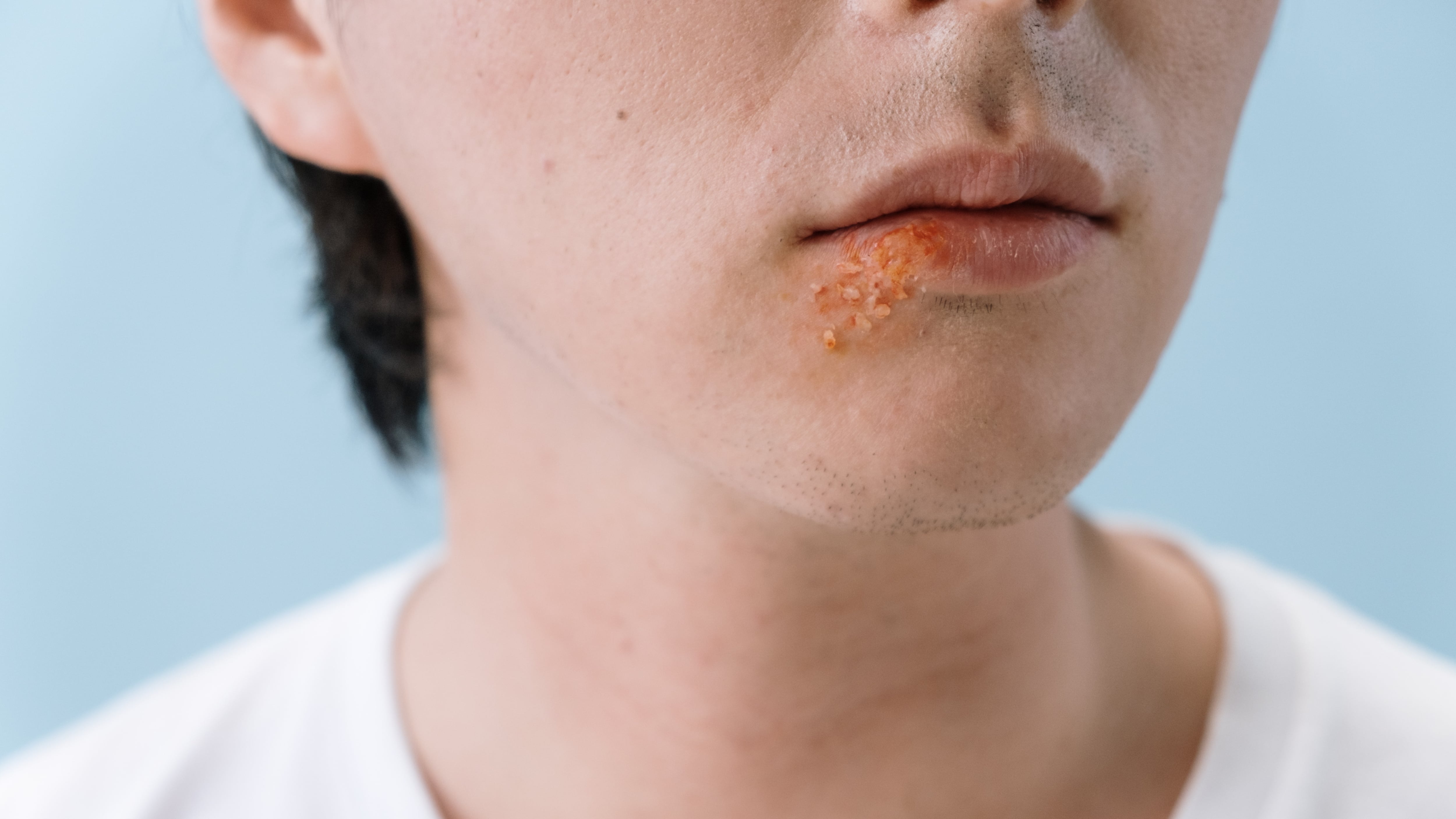 Ecco come l'herpes può distruggere le cellule tumorali