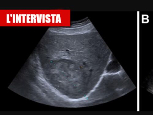 Così il Covid attacca anche il fegato