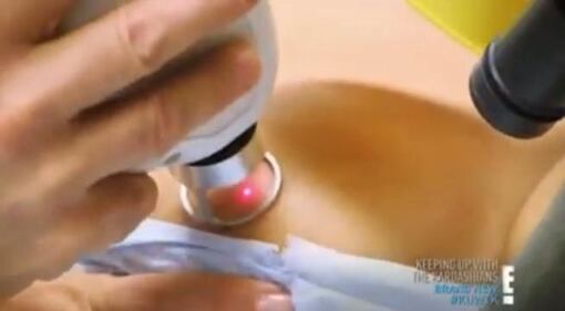 Kim Kardashian, laser sul seno per rimuovere le smagliature 7