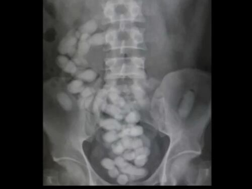 Cagliari, fermato corriere della droga: 31 ovuli nell’intestino
