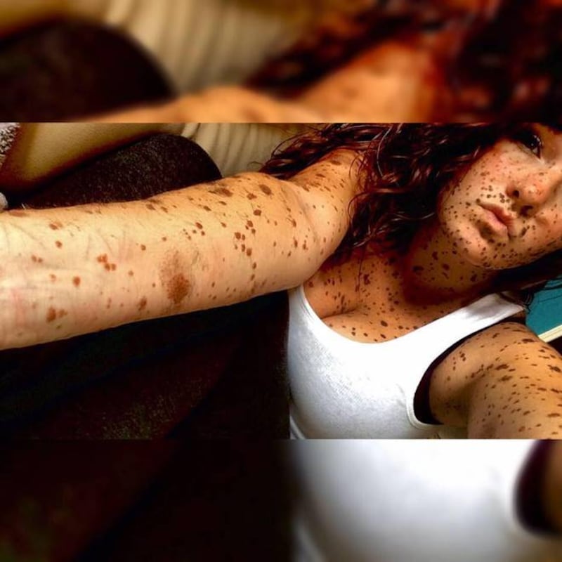 Ha il corpo coperto dai nei: "Così ho reagito al bullismo" 1