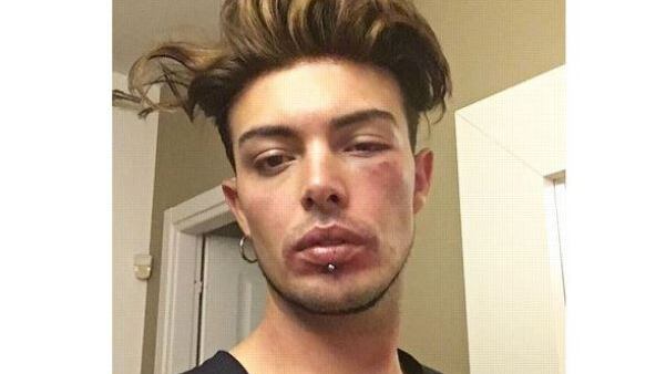 Stash e la foto col volto pestato: "Stavo difendendo una ragazza"