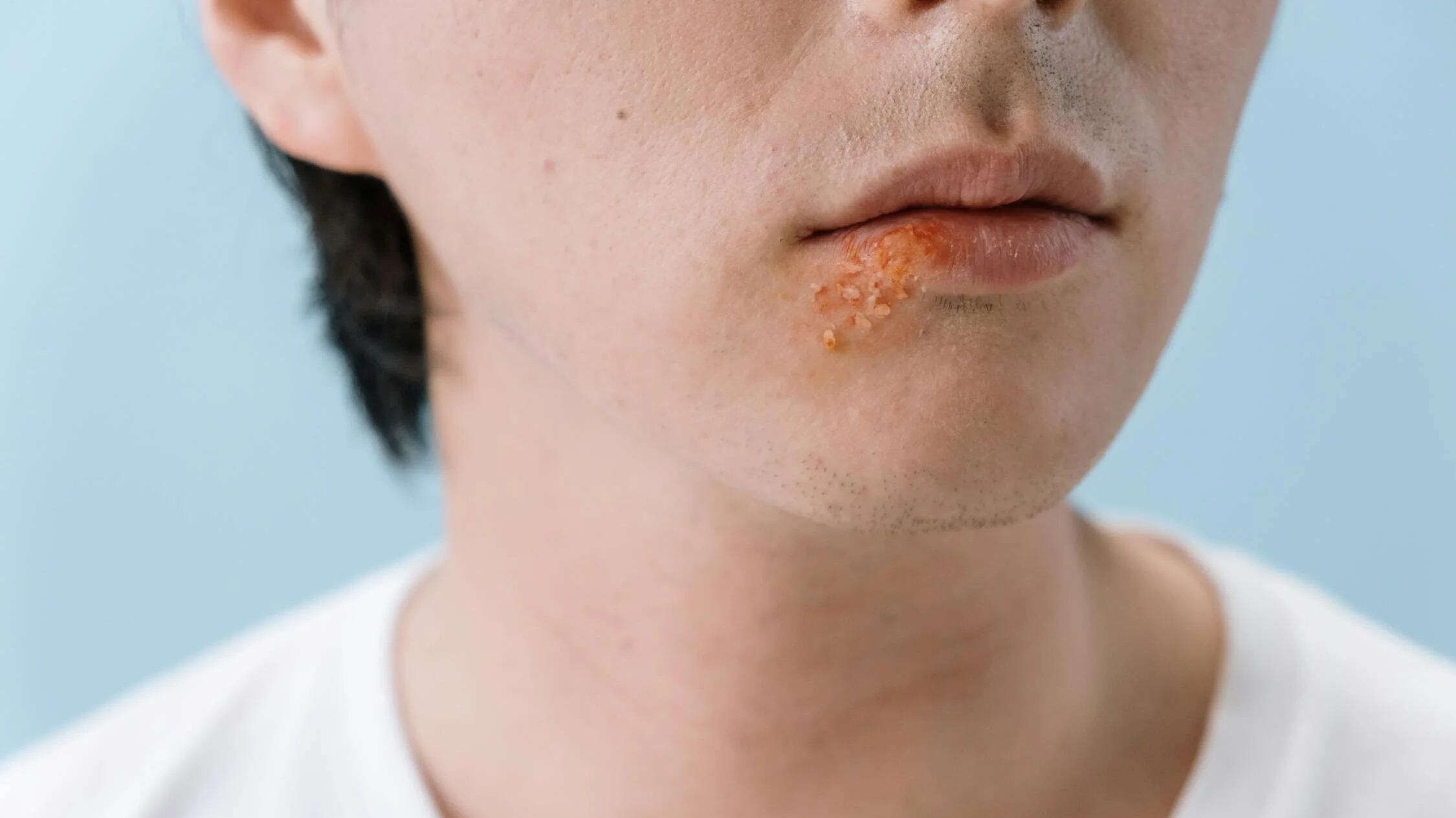 Herpes labiale, l'insidia nascosta: ecco gli effetti che può avere sul cervello