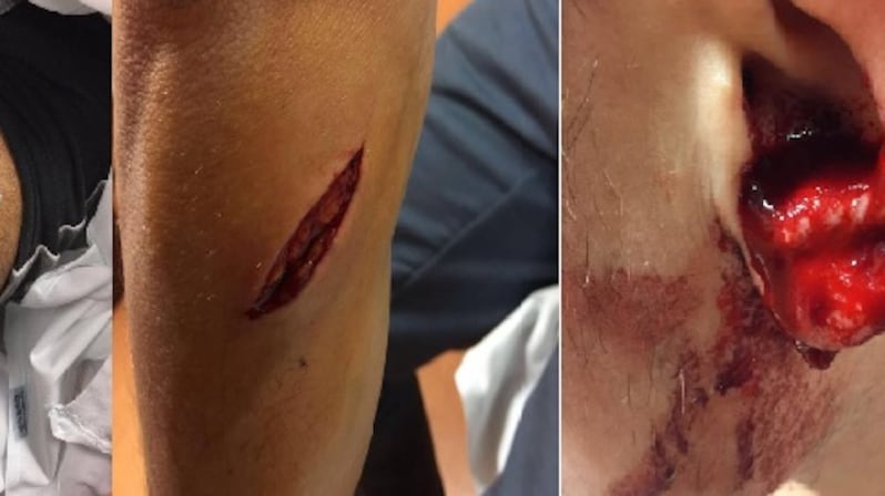 Napoli, poliziotti aggrediti in strada. Coltellate al petto e al volto