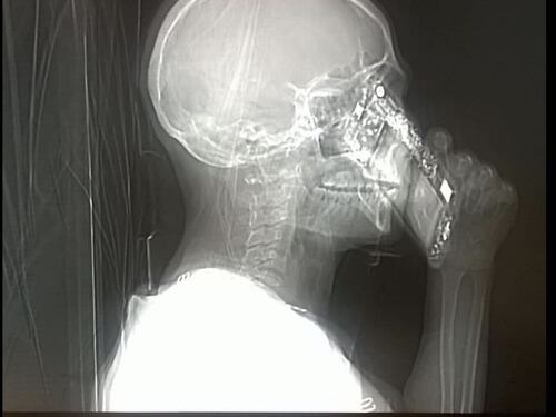 Risponde al cellulare durante la Tac, medici allibiti a Napoli