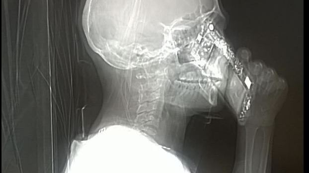 Risponde al cellulare durante la Tac, medici allibiti a Napoli