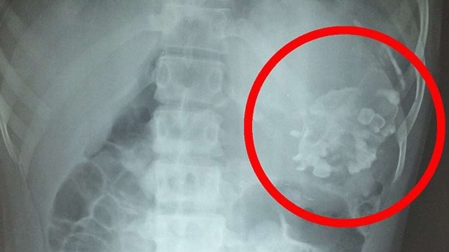 Ragazzo continua a perdere peso: nello stomaco ha un feto-parassita