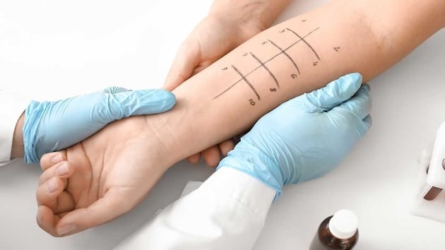 Quali test fare per valutare se si è allergici?