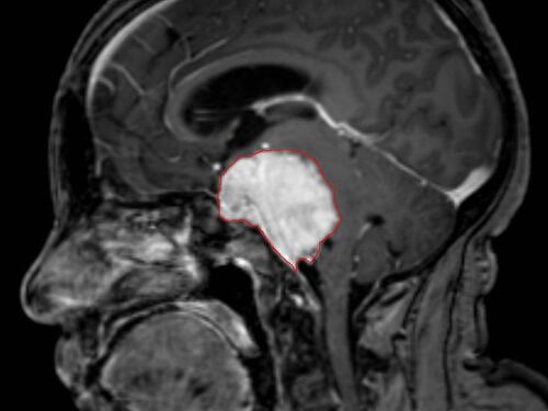 Meningioma, cos'è e quali sono i suoi sintomi
