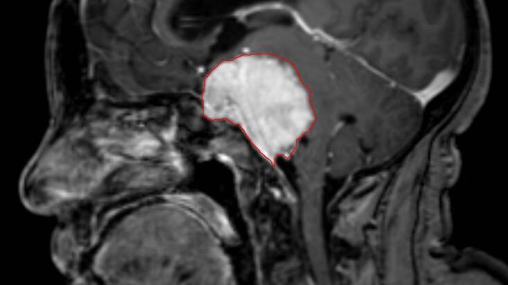 Meningioma, cos'è e quali sono i suoi sintomi