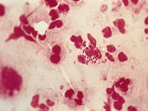 L'Oms lancia l'allerta, sempre più preoccupazione per la Gonorrea: "È resistente agli antibiotici"