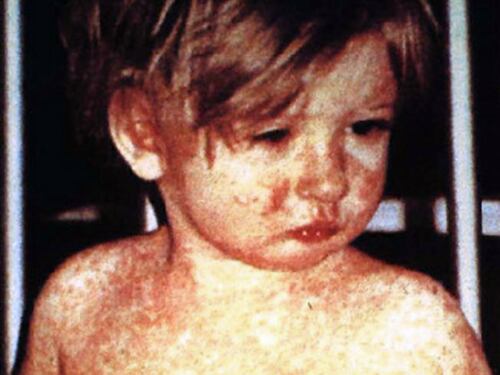 Allarme morbillo in Italia: "Decessi sono in aumento"