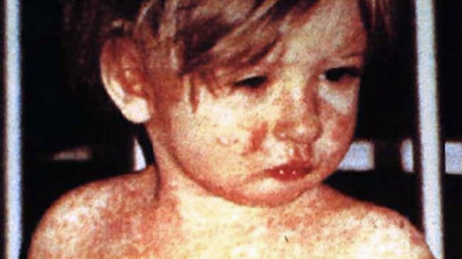 Morbillo, allarme dagli Usa: "Vaccinatevi prima di andare in Italia"