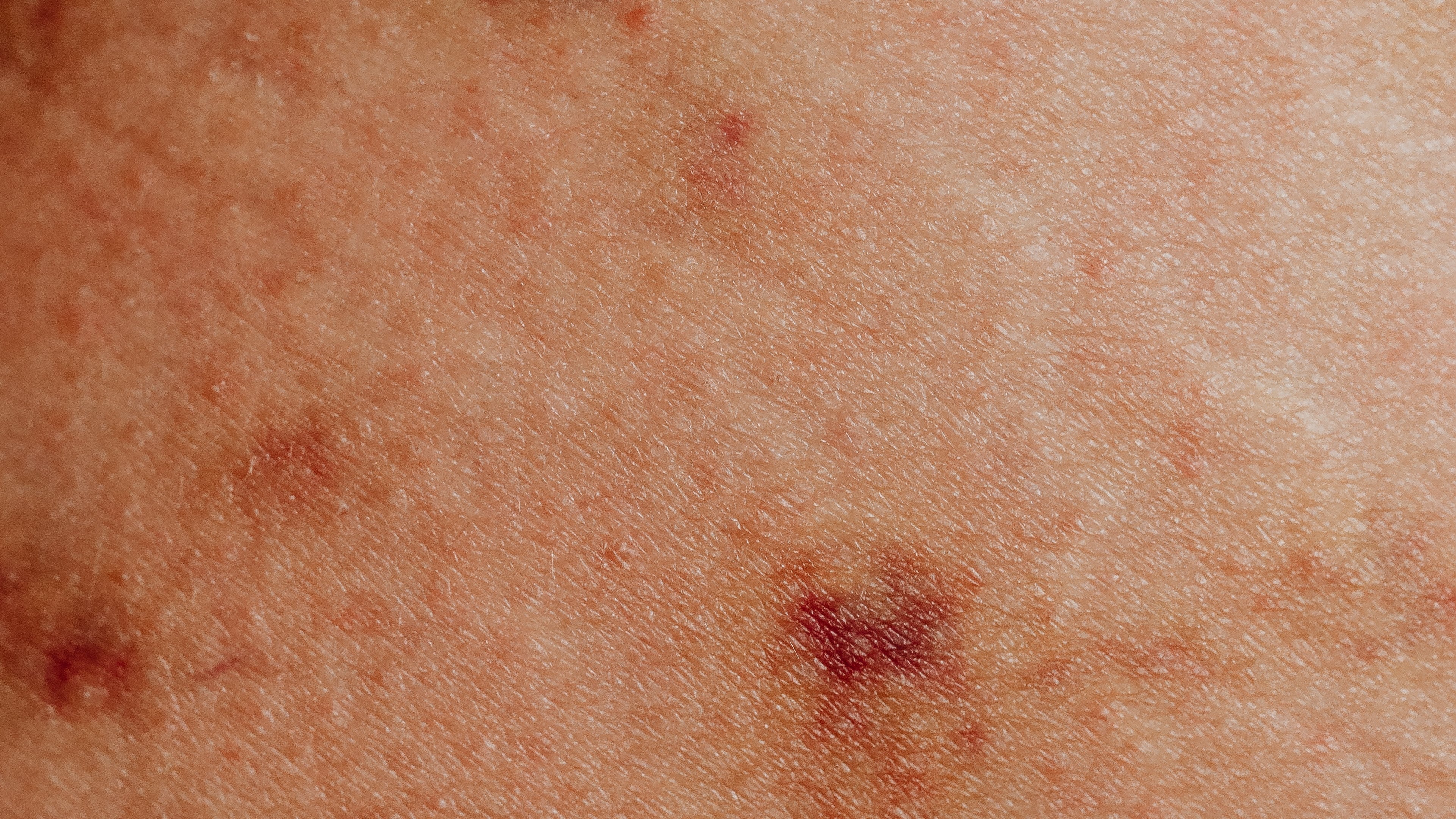 Macchie rosse sulla pelle: cause, rimedi e cure