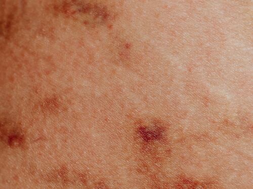 Macchie rosse sulla pelle: cause, rimedi e cure